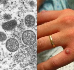 variola-do-macaco-europa-910x526-1